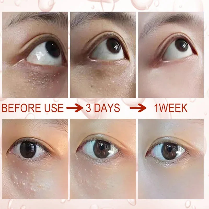 Fat Granules Remover Eye Cream Anti-puffiness Wrinkles Cream Lift